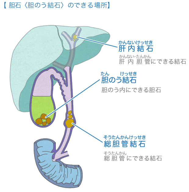 胆のうが病気になると胆石ができる場所。肝内胆管（かんないたんかん）と胆のうと総胆管（そうたんかん）の3か所にできます。