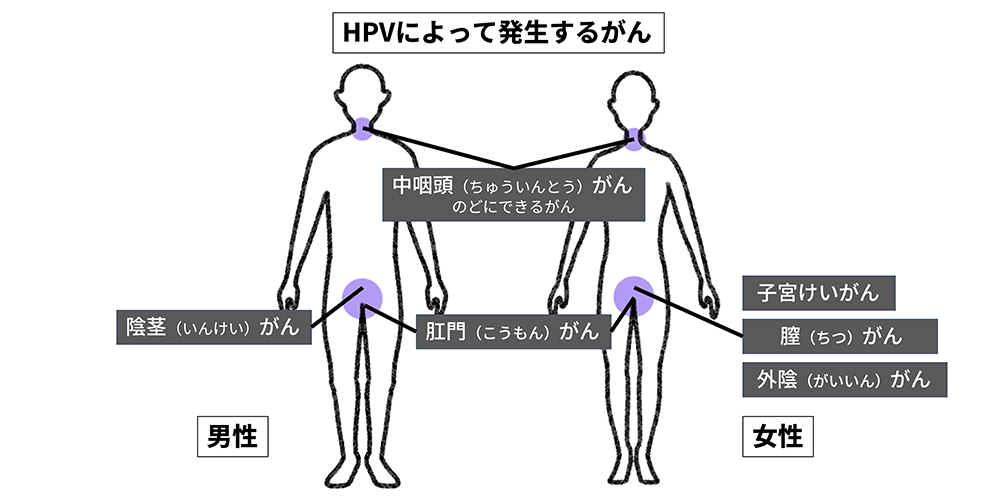 HPVによって発生するがんの説明。中咽頭がんと肛門がんは男女に、子宮頸がん、膣がん、外陰がんは女性に、陰茎がんは男性に発生する