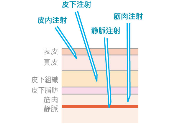 皮内注射、皮下注射、静脈内注射、筋肉内注射