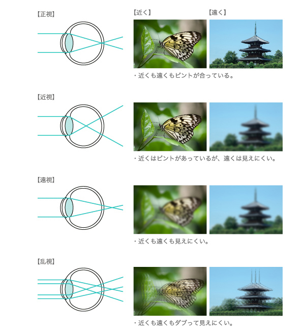 屈折異常