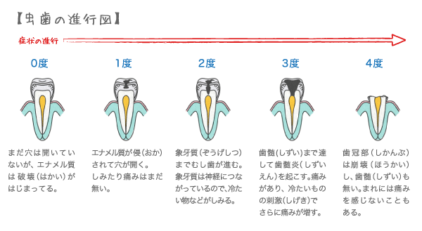 虫歯の進行図