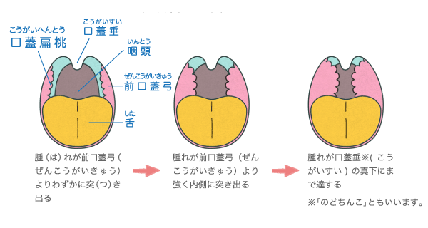 口蓋扁桃