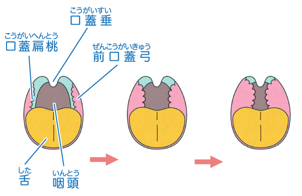 口蓋舌弓腫れ – 口蓋舌弓 痛い – FKRC