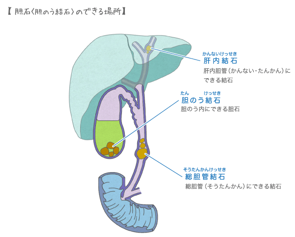 胆のうが病気になると胆石ができる場所。肝内胆管（かんないたんかん）と胆のうと総胆管（そうたんかん）の3か所にできます。