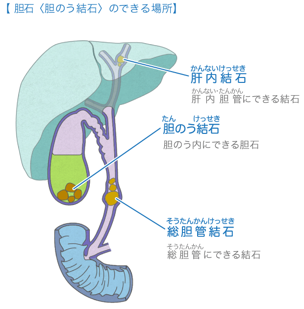 総 胆管 結石