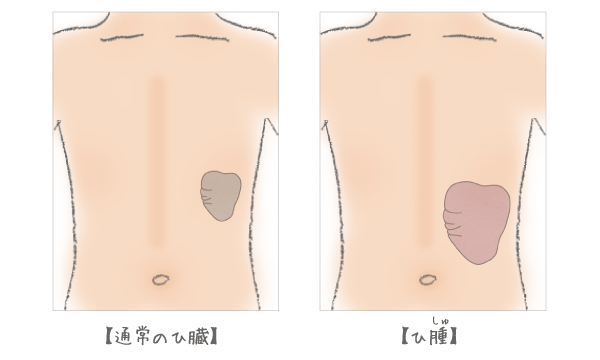 脾臓 痛み