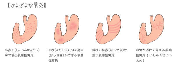 さまざまな胃炎