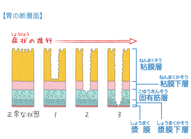 胃潰瘍