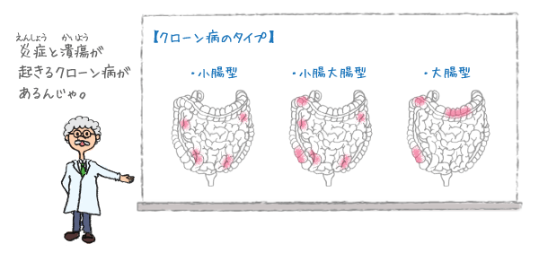 クローン病のタイプ