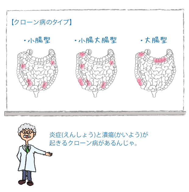 クローン病のタイプ