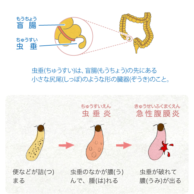盲腸