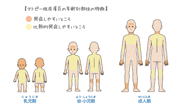 アトピー性皮膚炎の年齢別部位の特徴