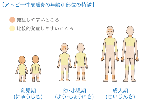 アトピー性皮膚炎の年齢別部位の特徴