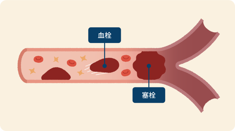 血栓症