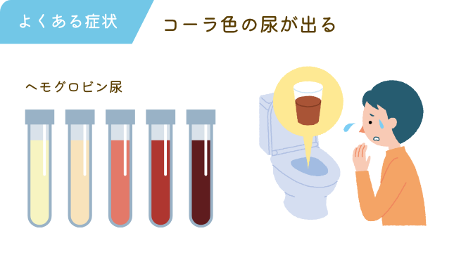 コーラ色の尿が出る